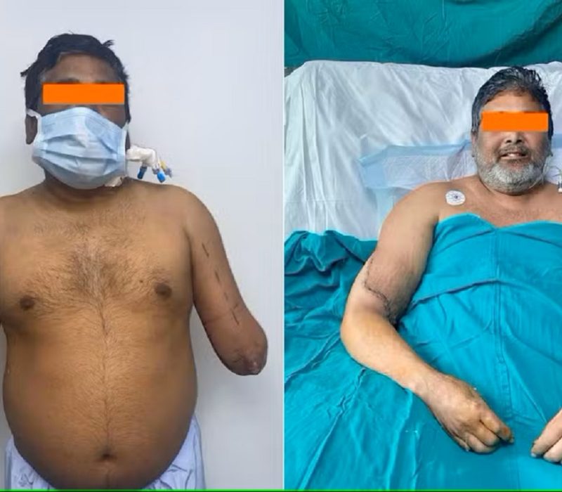 transplante_maos_indiano